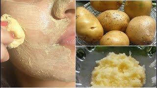 it removed my Dark Spots in 30 Days Potato Facial Mask for Hyper pigmentation,Skin Whitening,Pimples