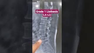 Grade 1 Listhesis L4-L5...Dr Sai Chandra