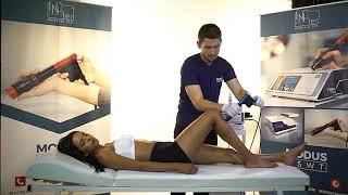 ESWT Tedavi Uygulamaları ESWT Treatment Patellar Tendinitis