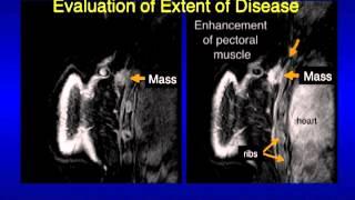 UCSF Radiology: Mammography Images Revealing What Cancer Looks Like