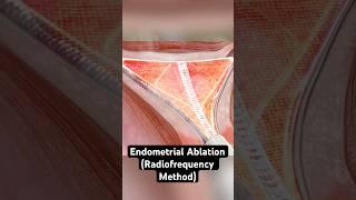 Using radiofrequency energy to reduce menstrual bleeding (3D animation)