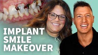  Implant Smile Makeover - Is It Really Possible to SMILE AGAIN?