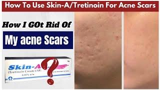 Does Tretinoin/ Skin-A Actually Treat YourAcne Scars?