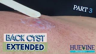 Part 3/3 Massive Back Cyst, Extended | HueVine