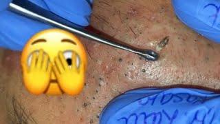 THE MOST VIEW...A FACE FULL OF BLACKHEADS... SATISFYING VIDEO