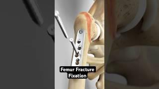 Femur Fracture Fixation (Dynamic Hip Screw Method)