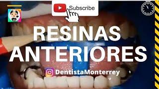 ⏩RESINAS ANTERIORES DIRECTASQuickVideo #ResinasDentales  #CompositeDental #ResinasDirectas