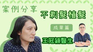 【FUT植髮｜真實見證】Lin「帽」似免了！不剃髮植髮衝一波！(成果篇)｜整形外科王冠穎醫師