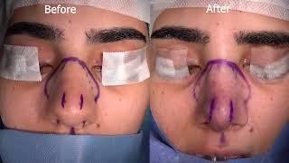 Wide Boxy Tip-33: Rhinoplasty Bizrah- London/ Dubai- Dr. Bashar Bizrah