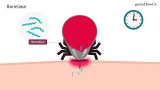 Borreliose: Welche Krankheiten übertragen Zecken?