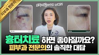 흉터치료를 10번 넘게 받아도 효과가 없었던 이유는? l 피부과전문의의 흉터치료방법