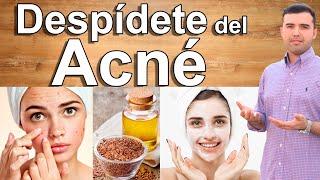 COMO CURAR EL ACNE - Como Eliminar el Acne y Sus Manchas Naturalmente y Para Siempre