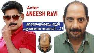 Next "Onam" with full hair Actor Aneesh Ravi, weakest Donor Area Hair Transplantation