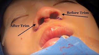 Asian Open Rhinoplasty by Doctor Kian Karimi MD, FACS