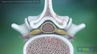 Osteophytes bone spurs Definition