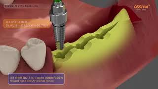 ESSET KIT: Easy Split & Expansion at Narrow Ridge