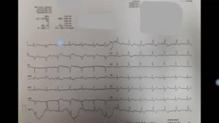 Ecg Shot z 11.07.2017