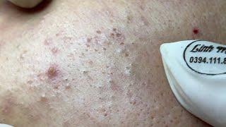 Acne treatment for Spa Linh Mun 2023 #014