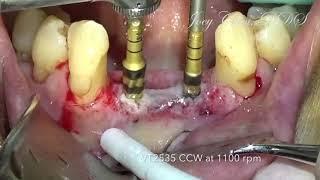 Ridge Splitting with Densah Burs