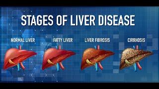 WATCH WHAT DOCTORS SAID ABOUT LIVER DISEASE