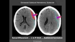 Subdural Hematoma (SDH)