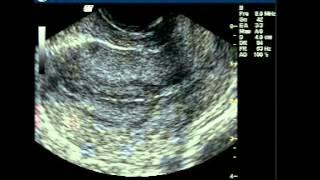 Uterine Contractions Video