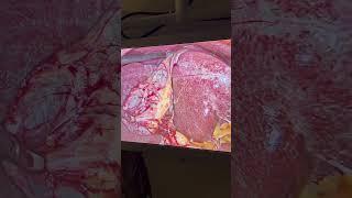 Gallbladder stones ? Treatment ? Surgery ? Laparoscopic surgery ? India I Surat I Gujarat