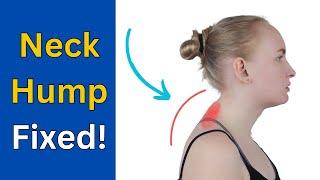How To Fix Neck Hump (Dowager’s Hump) - Neck Pain Also!