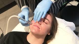 Microdermabrasion - Blackledge Face Center Open House 2021