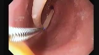 Endoscopic Extraction of the worm blocking the  pylorus