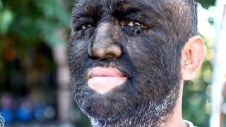 Meet the World's Hairiest Man