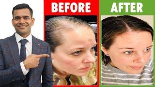 3 Home Remedies To Prevent Hair loss And Regrow Your Hair