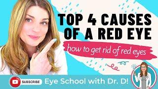 How To Get Rid Of Red Eyes | Top 4 Causes Of A Red Eye | An Optometrist Dishes all the Dirt!