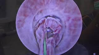 Core Videos (2023): Urethral Drug-Coated Balloon Dilation