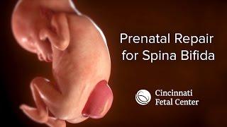 Spina Bifida Medical Animation | Cincinnati Fetal Center