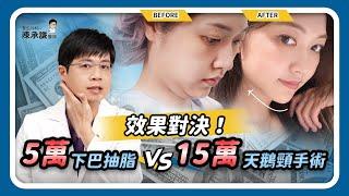 5萬雙下巴抽脂 vs 15萬天鵝頸手術，下顎線改造哪個更強？ | 陳承謙醫師