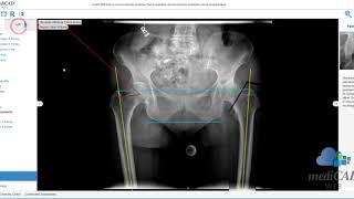 mediCAD Web 1.2 - Demovideo Hip Planning