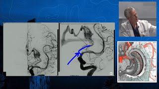 Episode 6: Capitalize - Basal Ganglia Arteriovenous Malformation