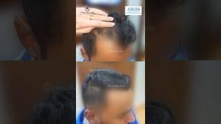 Hair Transplant Before & After Results | Transform Your Look | #shorts #hairtransplant #hairloss