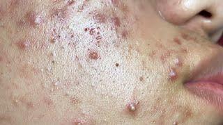 Make your Acne Treatment Huong Da Nang | 482# acne 2022