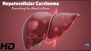 Fighting Hepatocellular Carcinoma: Key Facts