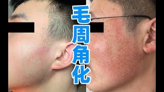 低成本改善面部“鸡皮肤”，脸上的毛周角化怎么治？