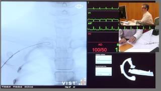 Mentice VIST®-C -  Catheterisation of the Left Coronary Artery From Right Radial Artery