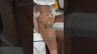 SCAR FREE TATTOO REMOVAL ep870 #short