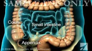 Appendicitis- Medical Animation