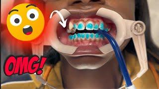 HOW BRACES ARE PUT ON‼️(LIGHTFORCE)-Shullman Orthodontics Wellington, Florida