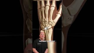 Tiny Wrist Ligament Causing BIG Problems #shorts