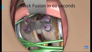 Neck Fusion in less than 60 seconds