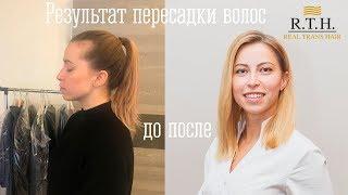 ОГО! ОТЗЫВ о ПЕРЕСАДКЕ ВОЛОС в клинике REAL TRANS HAIR!