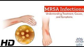 MRSA Unmasked: A Comprehensive Guide to Causes, Symptoms, and Treatment